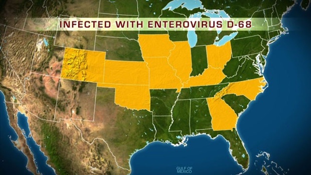 Enterovirus D68: What You Should Know